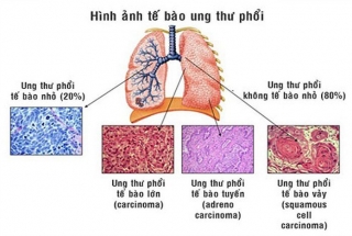 VAI TRÒ XÉT NGHIỆM TÌM ĐỘT BIẾN GEN EGFR VÀ ALK TRONG ĐIỀU TRỊ UNG THƯ PHỔI KHÔNG TẾ BÀO NHỎ